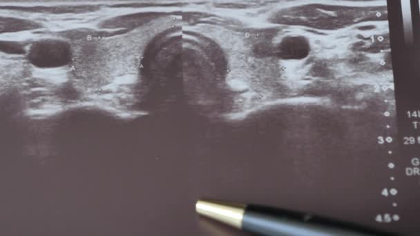 Endocrinólogo Analiza Ultrasonido Glándula Tiroides — Vídeos de Stock