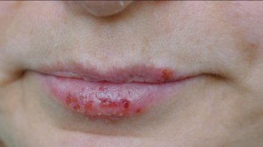 Dudaklarda herpes simpleks.