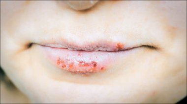 Dudaklarda herpes simpleks.