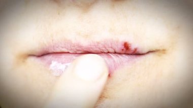 Dudaklarda herpes simpleks.