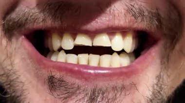 İnsan ağzında hasarlı ve kırık ön dişler. Diş sağlığı sorunu, ağız temizliği sorunu, kapalı alandaki diş kusurlarını yakından görme sorunu..