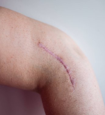 Dirsek ameliyatından sonra kolunda yara izi var.