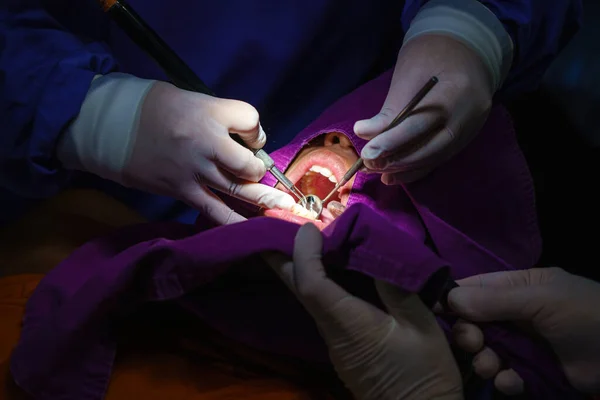 Lekarz Czyszczący Zęby Pomocą Narzędzia Ultradźwiękowego Usunięcie Tatuażu Płytki Nazębnej — Zdjęcie stockowe