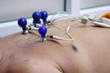 Elektrokardiyogram için elektrodları olan bir hastanın EKG 'si ya da EKG' si hastanede yatıyor.