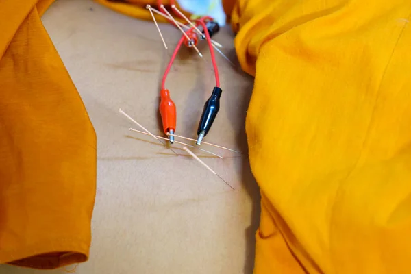 doctor sticks needles into the girl\'s back on acupuncture with Electrical stimulator.