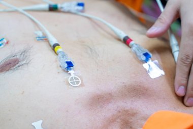Elektrokardiyogram için elektrodları olan bir hastanın EKG 'si ya da EKG' si hastanede yatıyor..