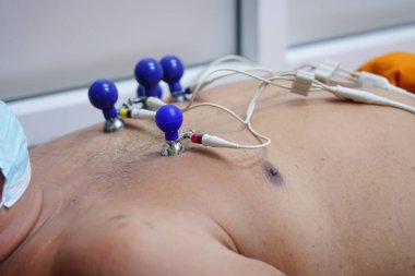 Elektrokardiyogram için elektrodları olan bir hastanın EKG 'si ya da EKG' si hastanede yatıyor.