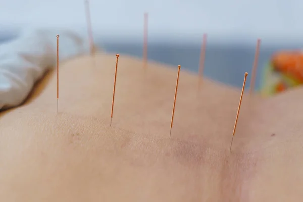 doctor sticks needles into the human body on the acupuncture. Traditional Chinese Medicine. acupuncture treatment.