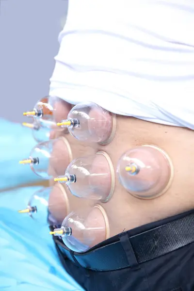 Close up multiple vacuum cups, medical cupping therapy on human body. Doctor with cups for patient, therapy. Wellness, health injury rehabilitation concept.