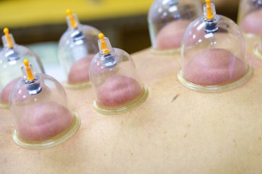 Çoklu vakumlu bardaklar için yakın çekim, insan vücuduna uygulanan tıbbi tedavi. Hasta için bardakları olan bir doktor, terapi. Sağlık, sağlık yaralanması rehabilitasyon konsepti. Alternatif tıp.