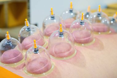 Çoklu vakumlu bardaklar için yakın çekim, insan vücuduna uygulanan tıbbi tedavi. Hasta için bardakları olan bir doktor, terapi. Sağlık, sağlık yaralanması rehabilitasyon konsepti. Alternatif tıp.