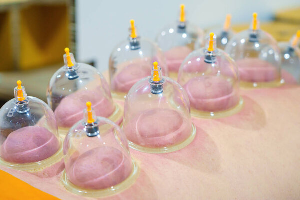 Закройте несколько вакуумных стаканчиков, лечебные пакетики терапии на теле человека. Врач с чашками для пациента, терапия. Концепция здорового образа жизни. Альтернативная медицина.