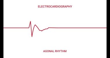 Animasyon EKG görüntüsü. Canlandırılmış Agonal Ritim