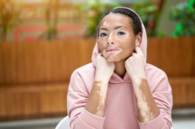 Black african american woman with vitiligo pigmentation skin problem indoor dressed pink hoodie put on a hood close up portrait with hand near face clipart