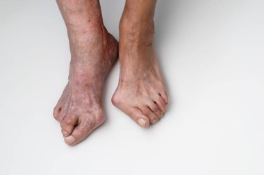 Üst çekimde yaşlı kadının ayakları görülüyor. Beyaz arka planda nasır ve hallux valgus izleri var. Ayak baş parmağıyla ayak parmağı arasında MTP ekleminde deformasyon var. 