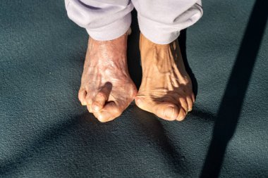 Overhead shot captures feet of senior woman, showing visible effects of bunion and hallux valgus, deformity of MTP joint connecting big toe to foot  clipart