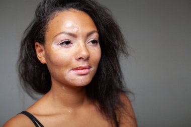 Cildinde vitiligo olan siyah Afrikalı bir kadının yakından çekilmiş portresi, düşünceli bir şekilde yana bakıyor. Gri bir arkaplanda, doğal güzelliğini ve benzersiz özelliklerini vurguluyor.