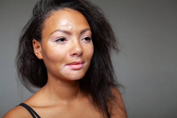 Крупный план портрета чернокожей женщины с витилиго на коже, задумчиво смотрящей в сторону. Захваченные на сером фоне, подчеркивающие ее природную красоту и уникальные черты