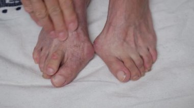 Yaşlı kadın ayak parmaklarına ve ayaklarına masaj yaparken HALLUX VALGUS ve BUNION belirtileri gösteriyor.