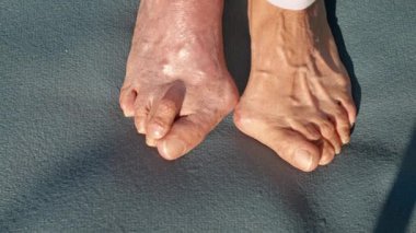Görünüşlerindeki ve dokularındaki katıksız kontrastı vurgulayan hallux valgus problemi, özel bir ayak durumunu ve bunun günlük yaşamdaki nasırını gösteriyor.