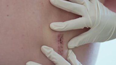 Tıbbi uzman, yaranın durumunu belirterek, hastanın sırtındaki iyileşme kesiğini inceliyor. İyileşme sürecinde dikkatli bir değerlendirme üzerinde yoğunlaşılmaktadır.