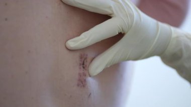Sağlık görevlisi ameliyattan sonra hastaların sırtlarındaki deri kesiklerini inceliyor. Profesyonel olarak düzgün iyileşme ve enfeksiyon belirtileri var mı diye dikkatlice kontrol et..