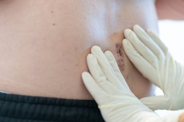 Tıbbi uzman, bir hastanın karnındaki cerrahi alanı incelikle inceliyor. Ayarlar temiz ve iyi aydınlatılmış bir tıbbi tesise benziyor. Muayene sırasında bakım yapılır..