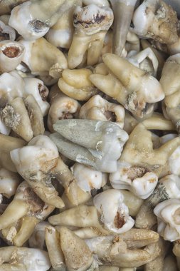 İstenmeyen çürük insan dişleri.. 