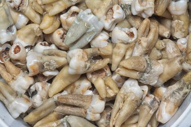 İstenmeyen çürük insan dişleri.. 