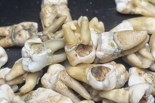 Bundle Unwanted Extracted Decay Human Teeth — Stock Photo, Image