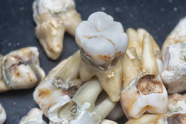Svazek Nechtěně Vytěžených Lidských Zubů — Stock fotografie