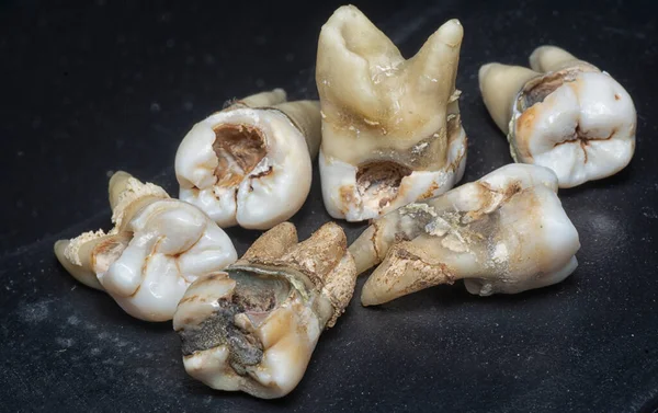Πακέτο Της Ανεπιθύμητης Αποσύνθεσης Ανθρώπινα Δόντια — Φωτογραφία Αρχείου