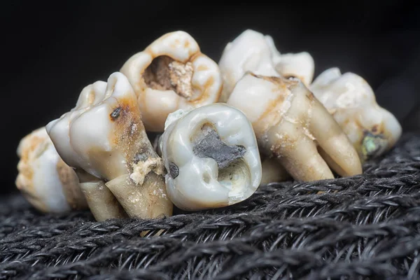 Feixe Dentes Humanos Decadência Extraídos Indesejados — Fotografia de Stock