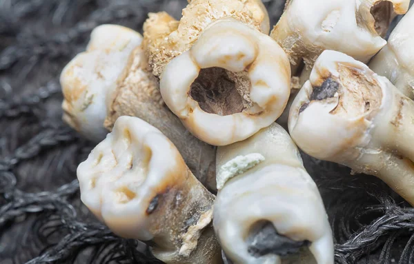 Bunten Oönskade Extraherade Förfall Mänskliga Tänder — Stockfoto