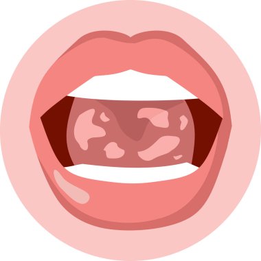 Vector Illustration of a Mouth Suffering from Candidiasis Infection clipart