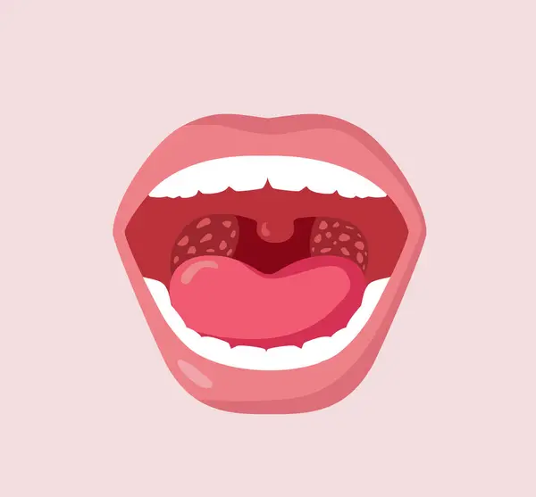 Tonsils Inflammation Vector Concept Image Open Mouth — Stock Vector