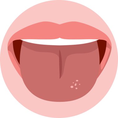 Dil Söndüren Ağızlı Vektör Tıbbi İllüstrasyon Simgesi