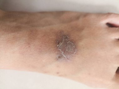 Yaya olarak isilik egzama dermatiti. Deride iltihap