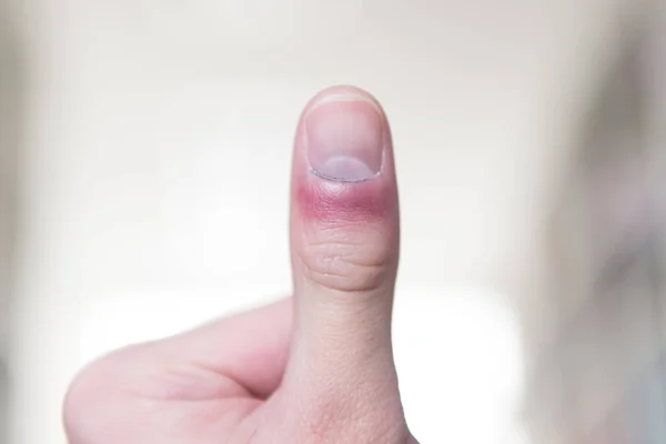 痛みの中で手と指を被る男 — ストック写真