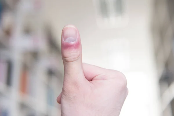 Hombre Sufriendo Mano Dedo Dolor —  Fotos de Stock