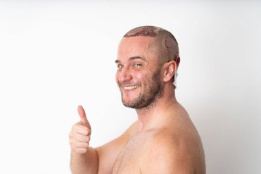 Smiling Man Shows Excitement Post Hair Surgery with Thumbs Up clipart