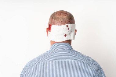 Taze ameliyat izleri ve kan lekeleri olan mavi tişörtlü bir adamın geçmişe bakışı