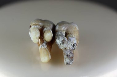 Hasta, hasarlı bir insan dişi. Arka plan siyah ve bulanık. Yakın plan..