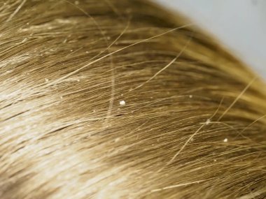 Görünür Kepek Gevrekleri, Kafa Derisi Sorunları ve Kişisel Hijyen Endişeleri İçin Yakın Çekim