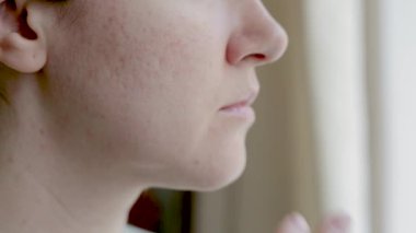 Sorunlu cilt pigmentleri olan bir kadının yüzü sivilce sonrası yaralar açar.