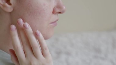 Sorunlu cilt pigmentleri olan bir kadının yüzü sivilce sonrası yaralar açar.