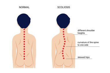 Omurgada omurga eğriliği hastalığın gelişiminin dört aşaması. Belirtilerin tarifi
