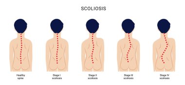 Omurgada omurga eğriliği hastalığın gelişiminin dört aşaması. Bir çocuğun arka görünüşü