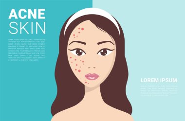 Sorunlu deri konsepti. Mavi arka planda yüzünde sivilceler olan üzgün bir kız. bir gencin vücudunda hormonal bozukluklar, vektör çizimi