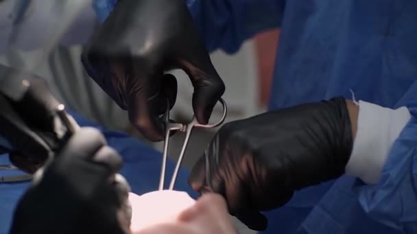 Крупный План Хирурги Руки Черные Перчатки Выполнить Операцию Удалению Удаленного — стоковое видео
